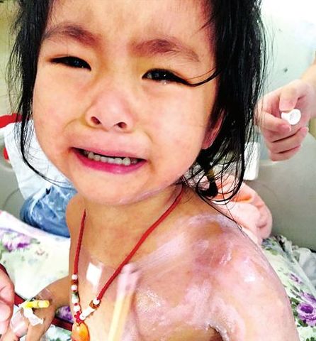 3歲的蘭蘭，全身紅疹，因疼癢難忍而大哭