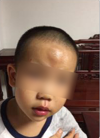 男童被送快遞的電動(dòng)車撞飛一米多，額頭腫起乒乓球大的包